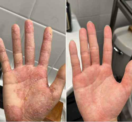 Kremas nuo odos uždegimo & sveika oda – malšina niežėjimą, paraudimą ir pleiskanojimą 50ml photo review